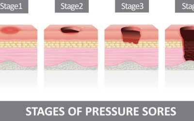 Decubitus, nyomási fekély, felfekvés